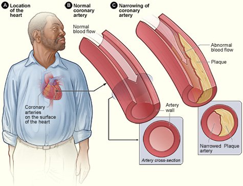 Coronary Heart Disease Diagram